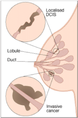 Diagram of breast lumps