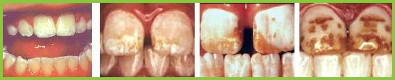 Dental Fluorosis